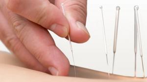 Akupunktioneuloja. Kuva: iStockphoto.