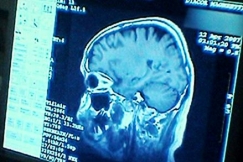 Kuva: R�ntgenkuva p��st�. YLE kuvanauha. 